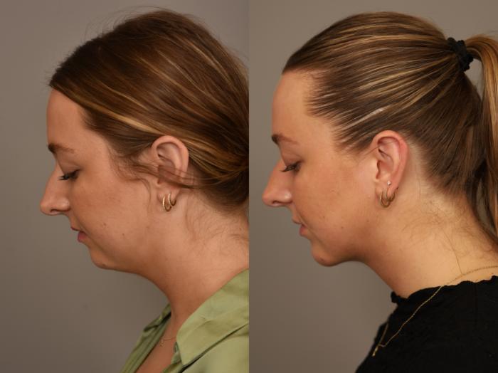 Before & After Chin Implant Case 318 Right Oblique View in New York, NY