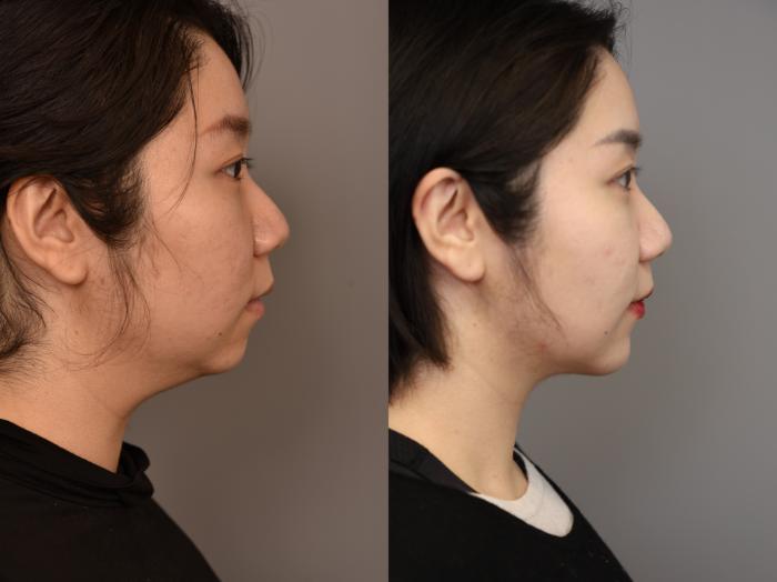 Before & After Chin Implant Case 319 Left Side View in New York, NY