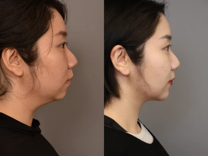 chin implant vs jaw implant comparison by NYC plastic surgeon Dr Thomas Sterry