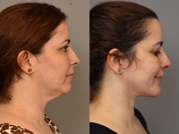 Before & After Chin Implant Case 320 Left Oblique View in New York, NY