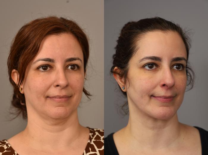 Before & After Chin Implant Case 320 Left Side View in New York, NY