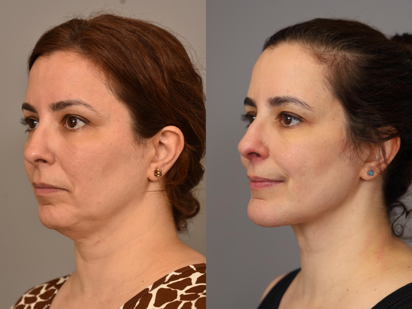 Before & After Chin Implant Case 320 Right Side View in New York, NY