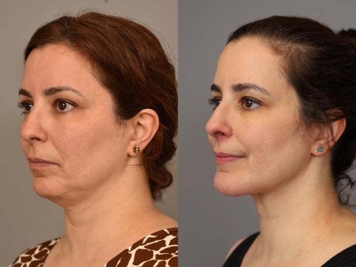Before & After Chin Implant Case 320 Right Side View in New York, NY