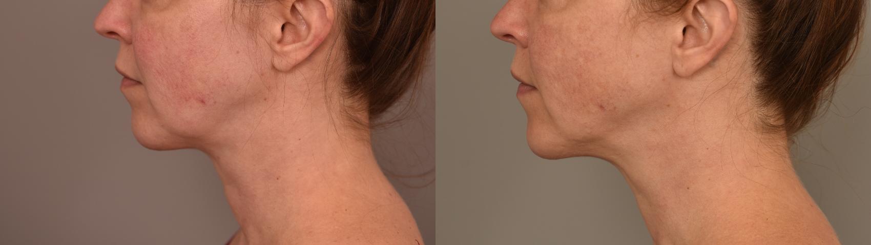 Before & After Chin Implant Case 321 Left Oblique View in New York, NY