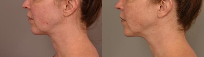 Before & After Chin Implant Case 321 Left Oblique View in New York, NY