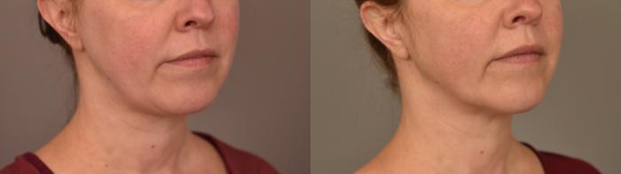 Before & After Chin Implant Case 321 Left Side View in New York, NY