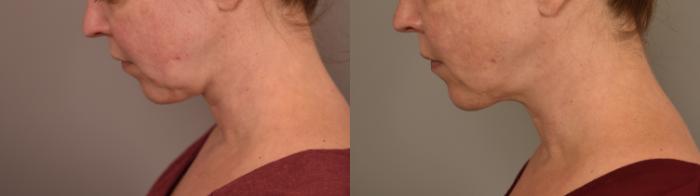 Before & After Chin Implant Case 321 Right Oblique View in New York, NY