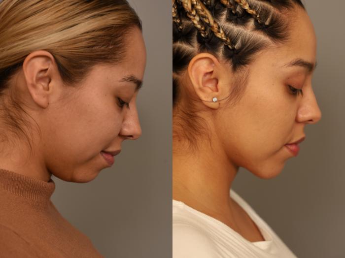 Before & After Chin Implant Case 322 Downward Gaze View in New York, NY