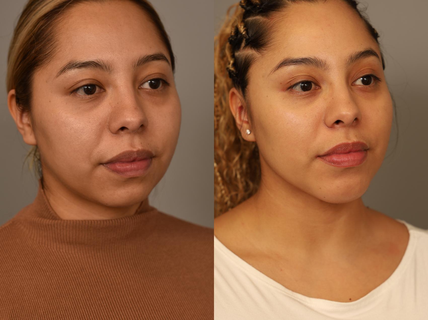 Before & After Chin Implant Case 322 Front View in New York, NY