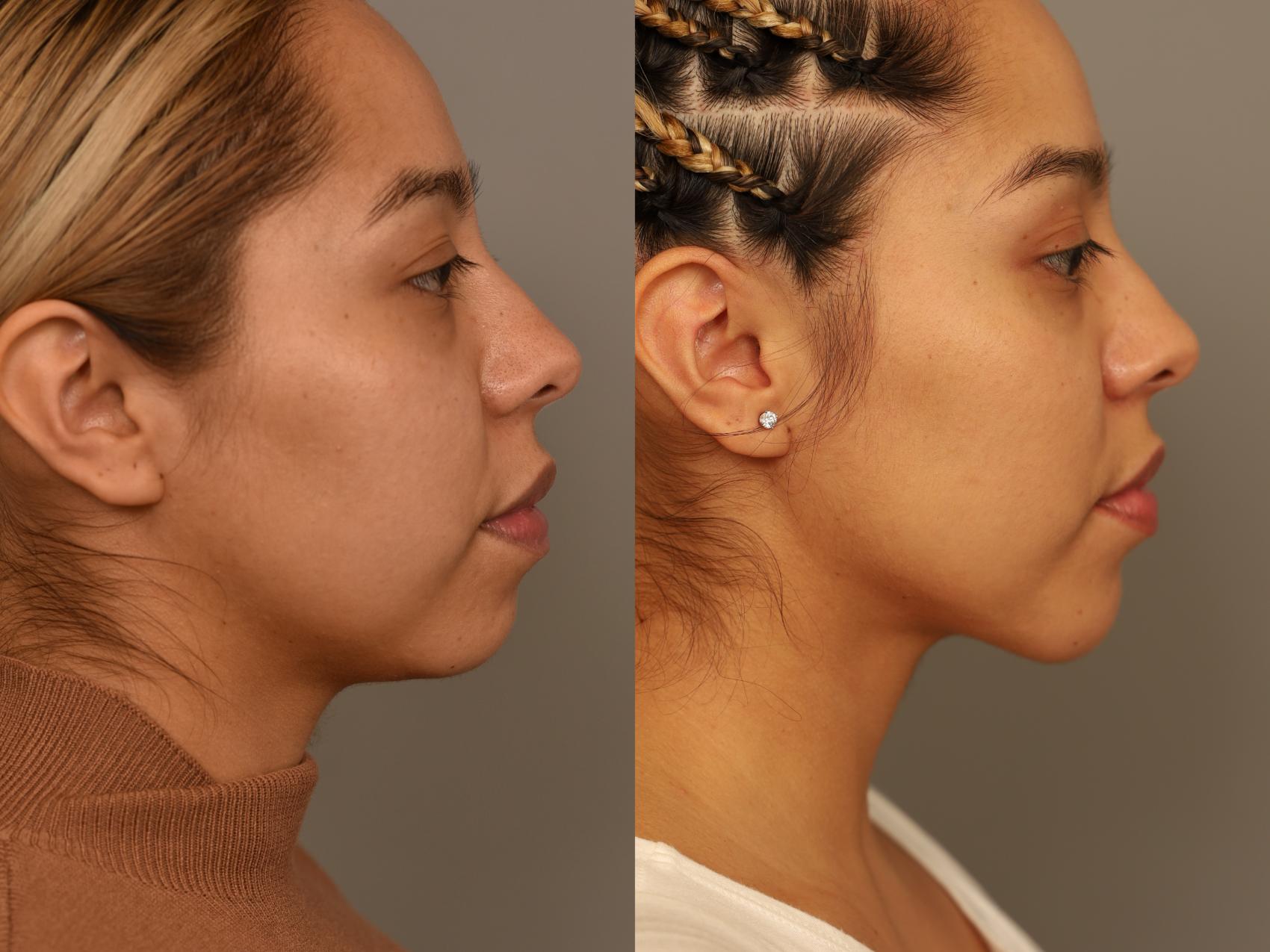 Before & After Chin Implant Case 322 Left Side View in New York, NY