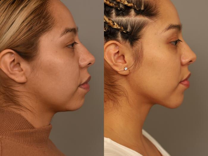 Before & After Chin Implant Case 322 Left Side View in New York, NY