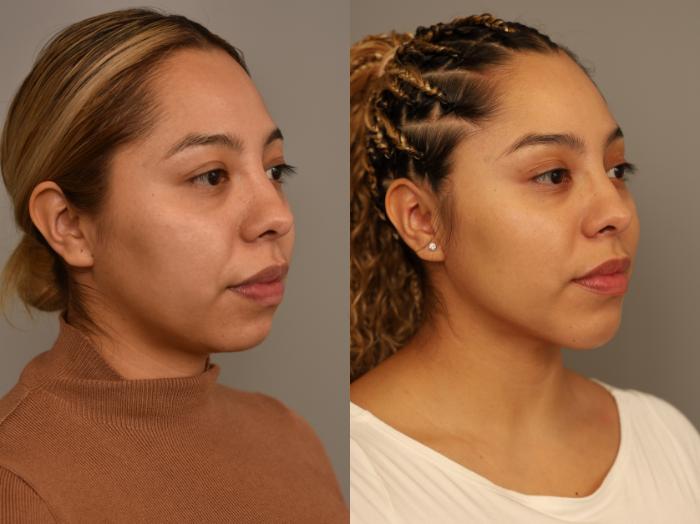 Before & After Chin Implant Case 322 Right Side View in New York, NY