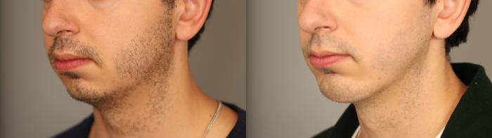 Before & After Chin Implant Case 326 Left Profile View in New York, NY