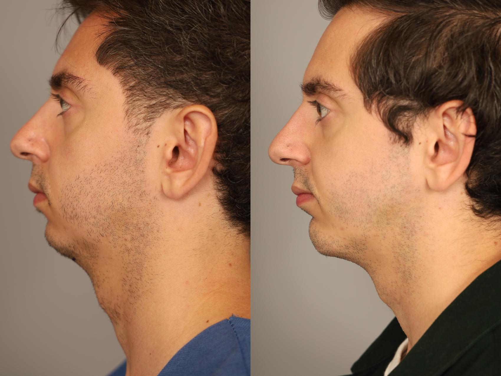 Before & After Chin Implant Case 326 Left Side View in New York, NY