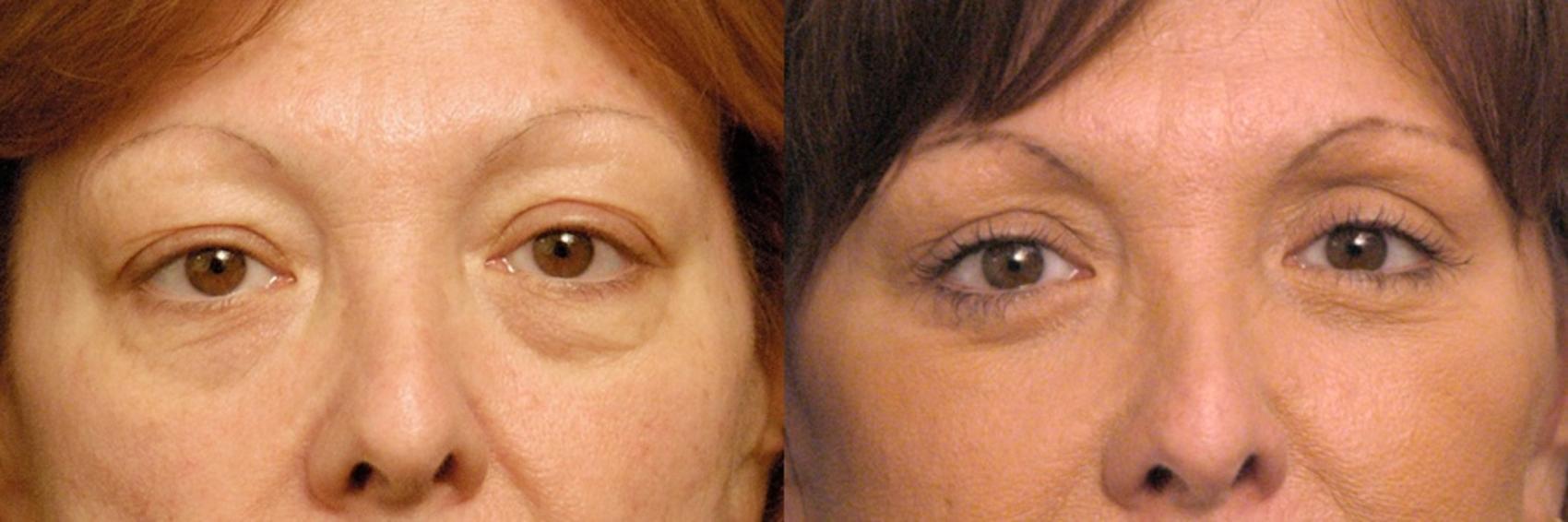 Before & After Eyelid Surgery Case 137 View #1 View in New York, NY