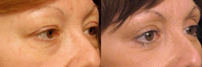 Before & After Eyelid Surgery Case 137 View #2 View in New York, NY