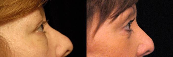 Before & After Eyelid Surgery Case 137 View #3 View in New York, NY