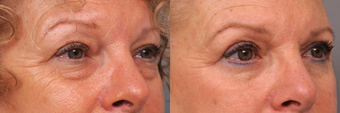 Before & After Eyelid Surgery Case 165 View #1 View in New York, NY