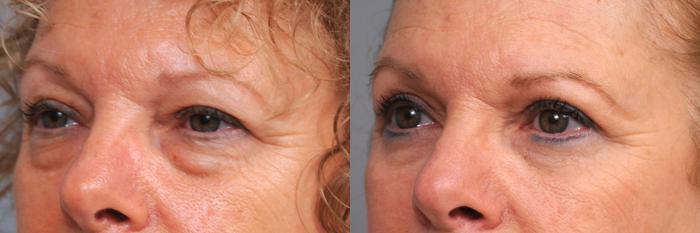 Before & After Eyelid Surgery Case 165 View #2 View in New York, NY