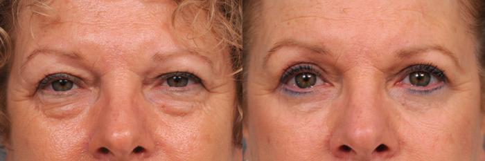 Before & After Eyelid Surgery Case 165 View #3 View in New York, NY