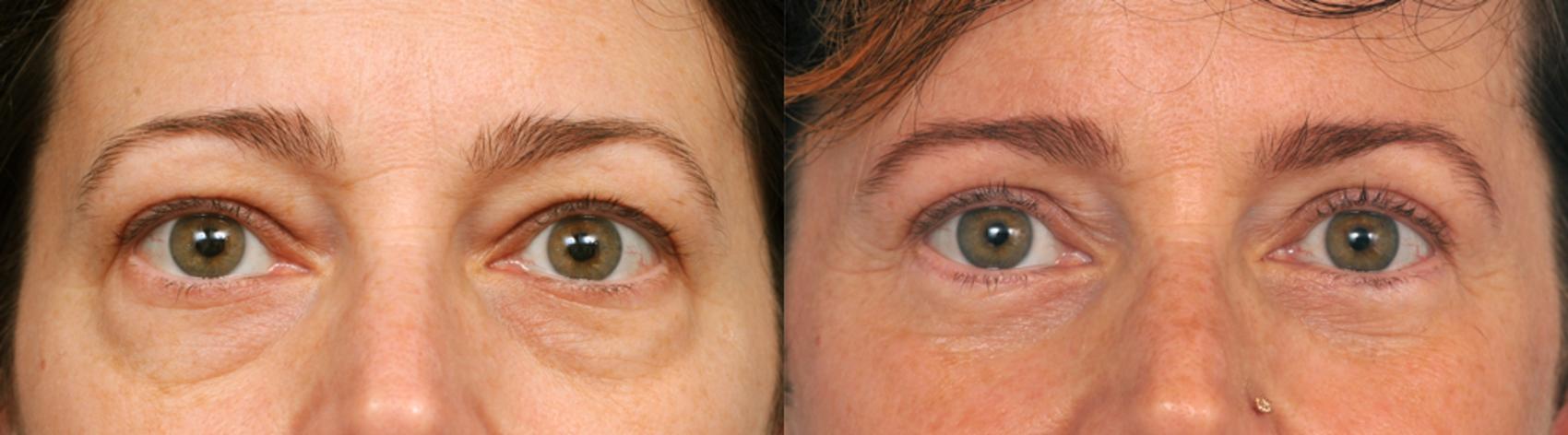 Before & After Eyelid Surgery Case 210 View #1 View in New York, NY