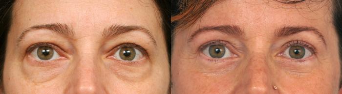 Before & After Eyelid Surgery Case 210 View #1 View in New York, NY