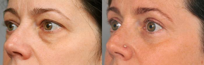 Before & After Eyelid Surgery Case 210 View #2 View in New York, NY