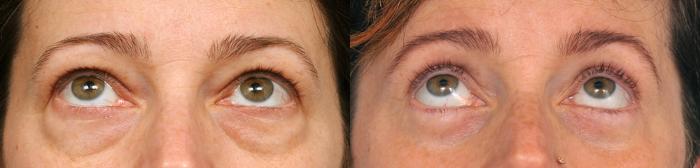 Before & After Eyelid Surgery Case 210 View #3 View in New York, NY