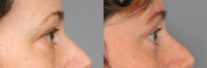 Before & After Eyelid Surgery Case 210 View #4 View in New York, NY
