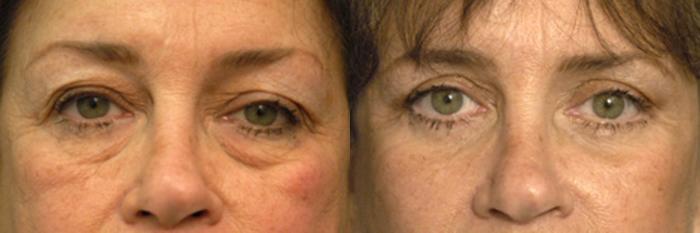 Before & After Eyelid Surgery Case 23 View #1 View in New York, NY