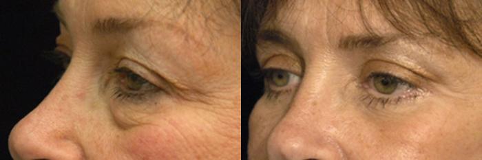 Before & After Eyelid Surgery Case 23 View #2 View in New York, NY