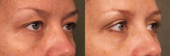 Before & After Eyelid Surgery Case 27 View #2 View in New York, NY