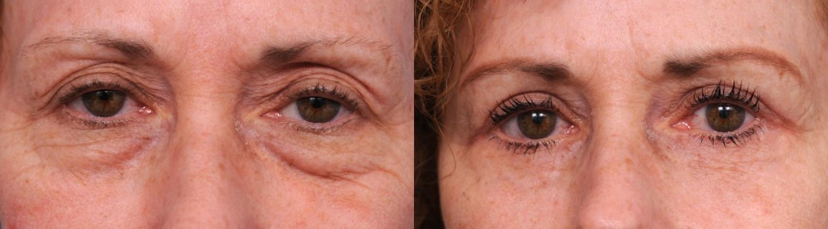 Before & After Eyelid Surgery Case 29 View #1 View in New York, NY