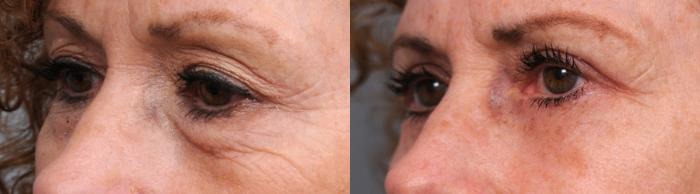 Before & After Eyelid Surgery Case 29 View #2 View in New York, NY
