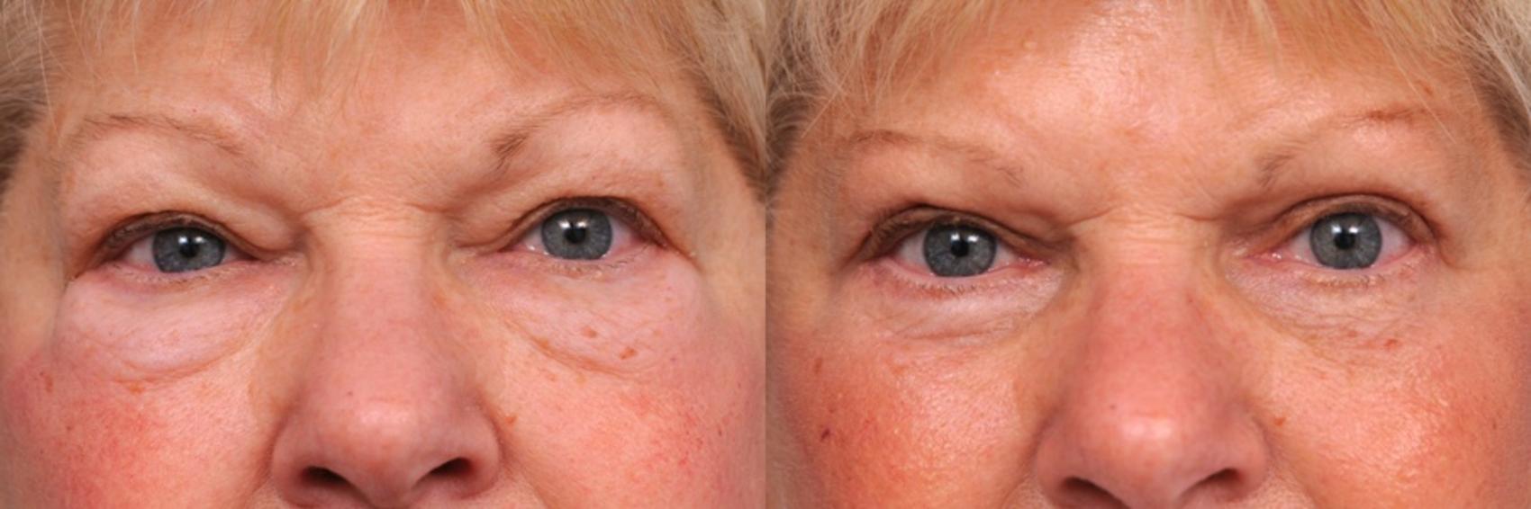 Before & After Eyelid Surgery Case 30 View #1 View in New York, NY