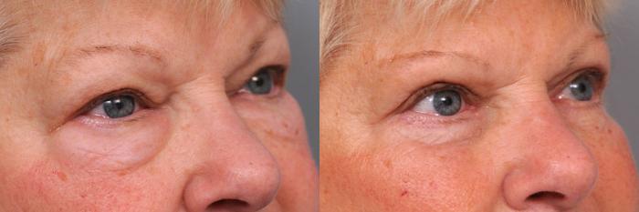 Before & After Eyelid Surgery Case 30 View #2 View in New York, NY