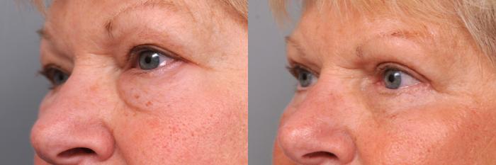 Before & After Eyelid Surgery Case 30 View #3 View in New York, NY