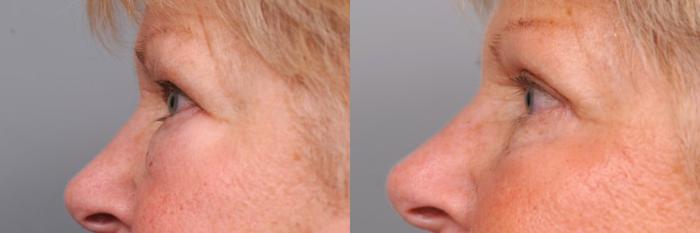 Before & After Eyelid Surgery Case 30 View #4 View in New York, NY