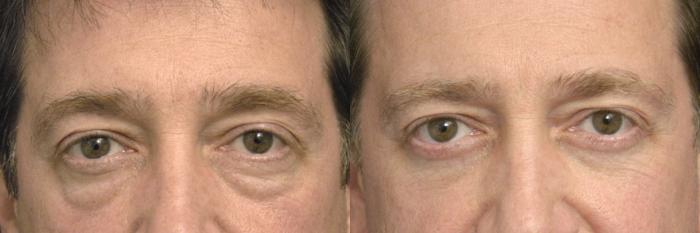 Before & After Eyelid Surgery Case 31 View #1 View in New York, NY