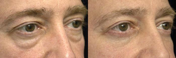 Before & After Eyelid Surgery for Men Case 31 View #2 View in New York, NY