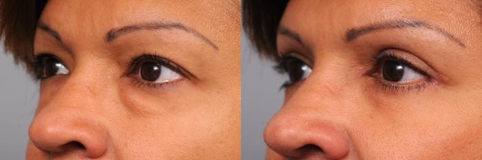 Before & After Eyelid Surgery Case 41 View #1 View in New York, NY