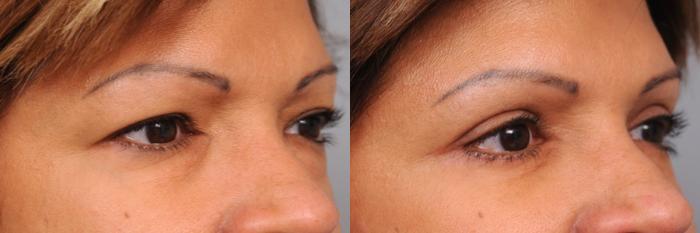 Before & After Eyelid Surgery Case 41 View #2 View in New York, NY