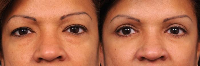 Before & After Eyelid Surgery Case 41 View #3 View in New York, NY
