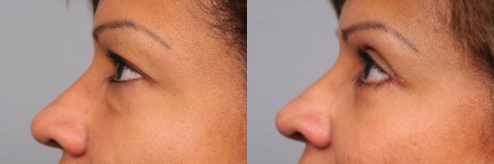 Before & After Eyelid Surgery Case 41 View #4 View in New York, NY