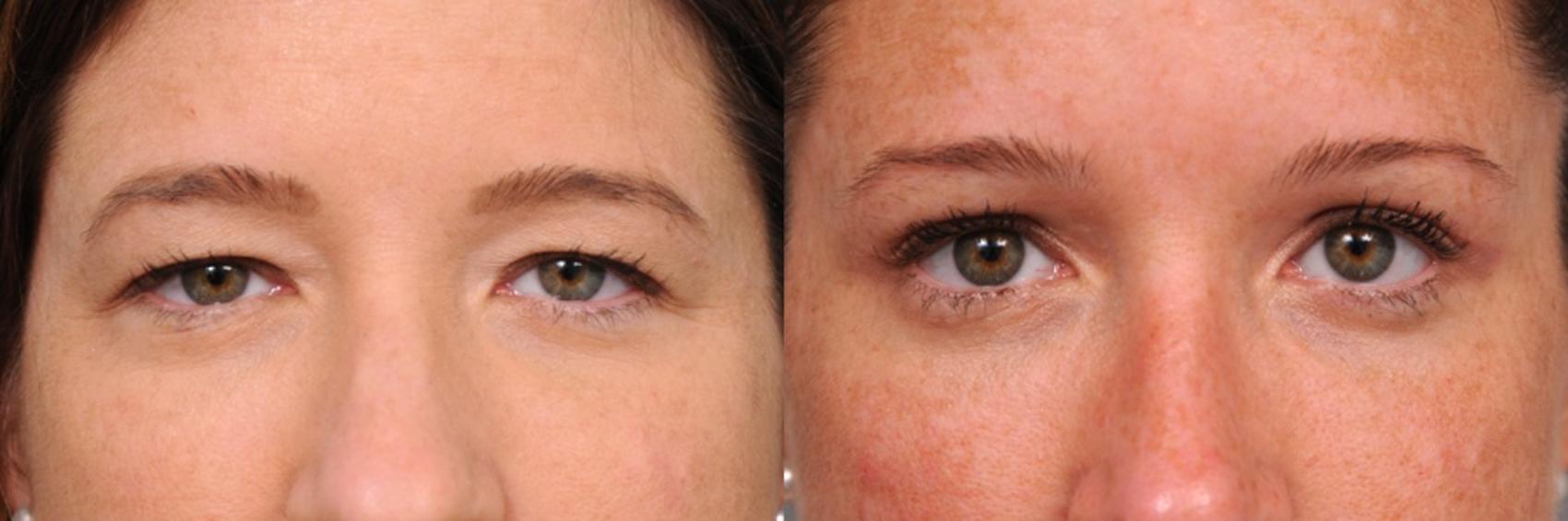 Before & After Eyelid Surgery Case 42 View #1 View in New York, NY
