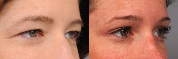 Before & After Eyelid Surgery Case 42 View #2 View in New York, NY