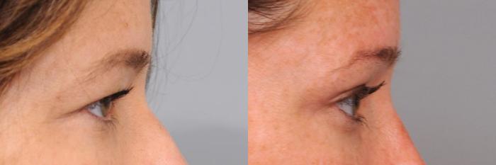 Before & After Eyelid Surgery Case 42 View #3 View in New York, NY