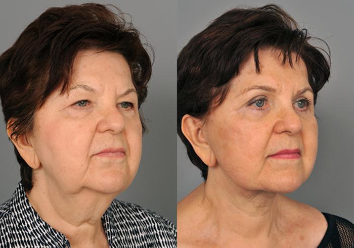 Before & After Facelift Case 217 View #3 View in New York, NY