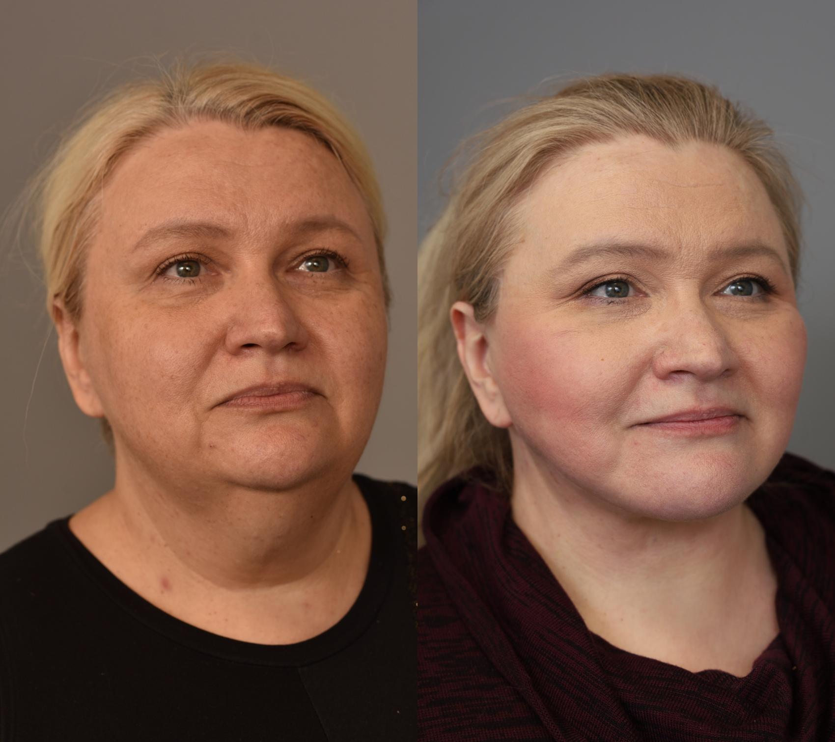 2 before and after photos of a woman who had a lower face deep plane face lift