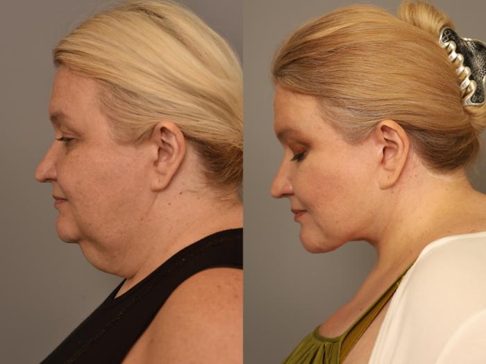 Before & After Facelift Case 278 Right Downward Angle View in New York, NY